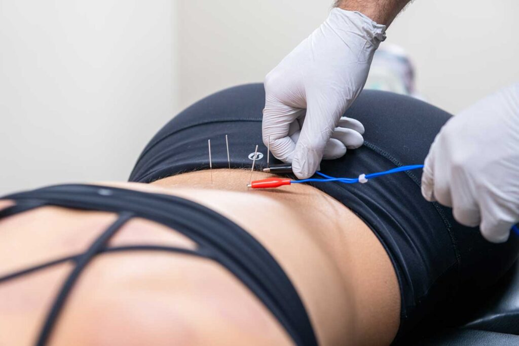 Dry needling acupuncture treatment session